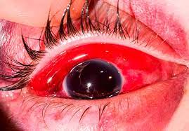 شکستگی کاسه چشم