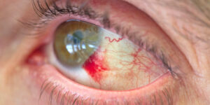 خونریزی کاسه چشم