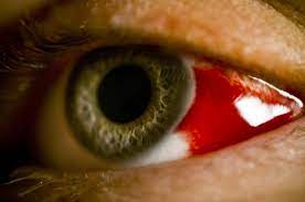 علائم خونریزی داخل چشم