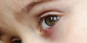 عفونت پلک چشم