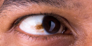 سرطان ملانومای چشم