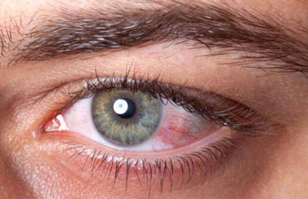 تومورهای پلک و حدقه چشم