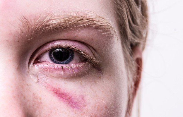 عوارض شکستگی کاسه چشم